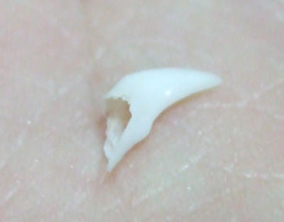 歯tb